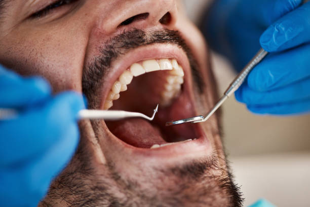 Best Broken or Cracked Tooth Emergency Dentist in Dania Beach, FL
